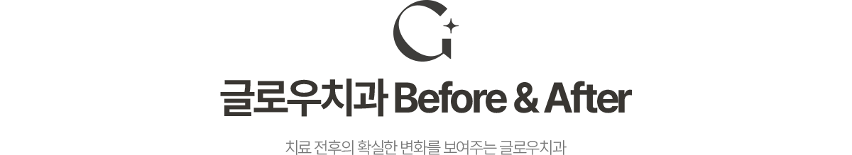 글로우치과 Before & After 치료 전후의 확실한 변화를 보여주는 글로우치과