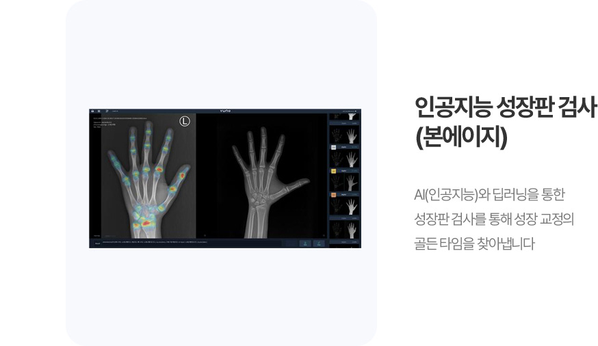 인공지능 성장판 검사 (본에이지)