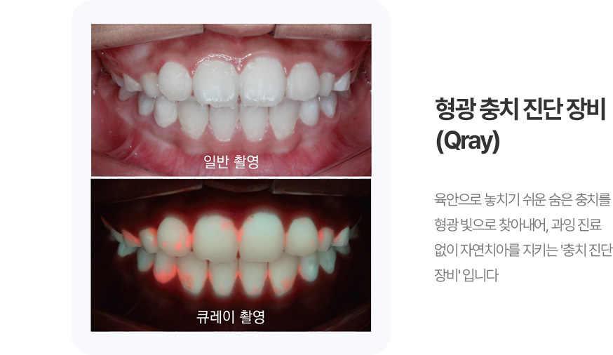형광 충치 진단장비 (Qray)