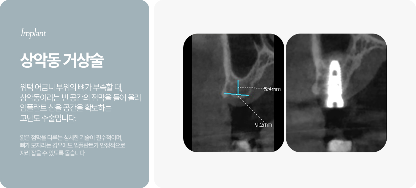전악 임플란트