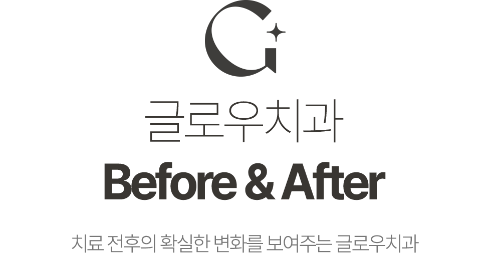 글로우치과 Before & After 치료 전후의 확실한 변화를 보여주는 글로우치과