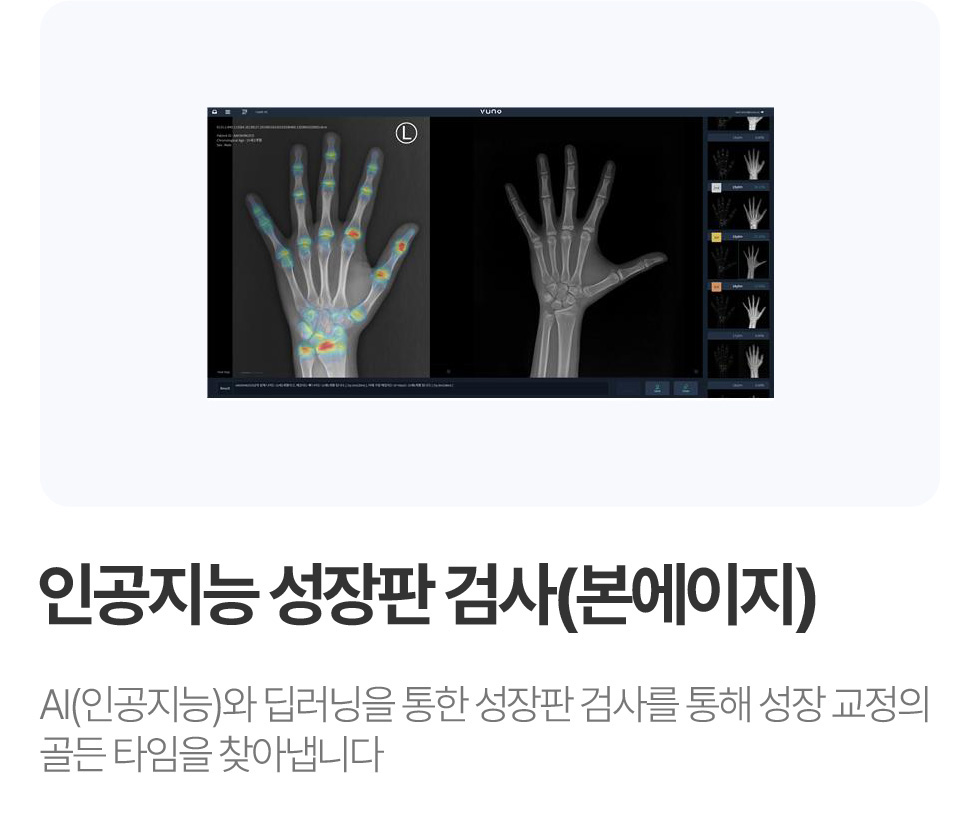 인공지능 성장판 검사 (본에이지)