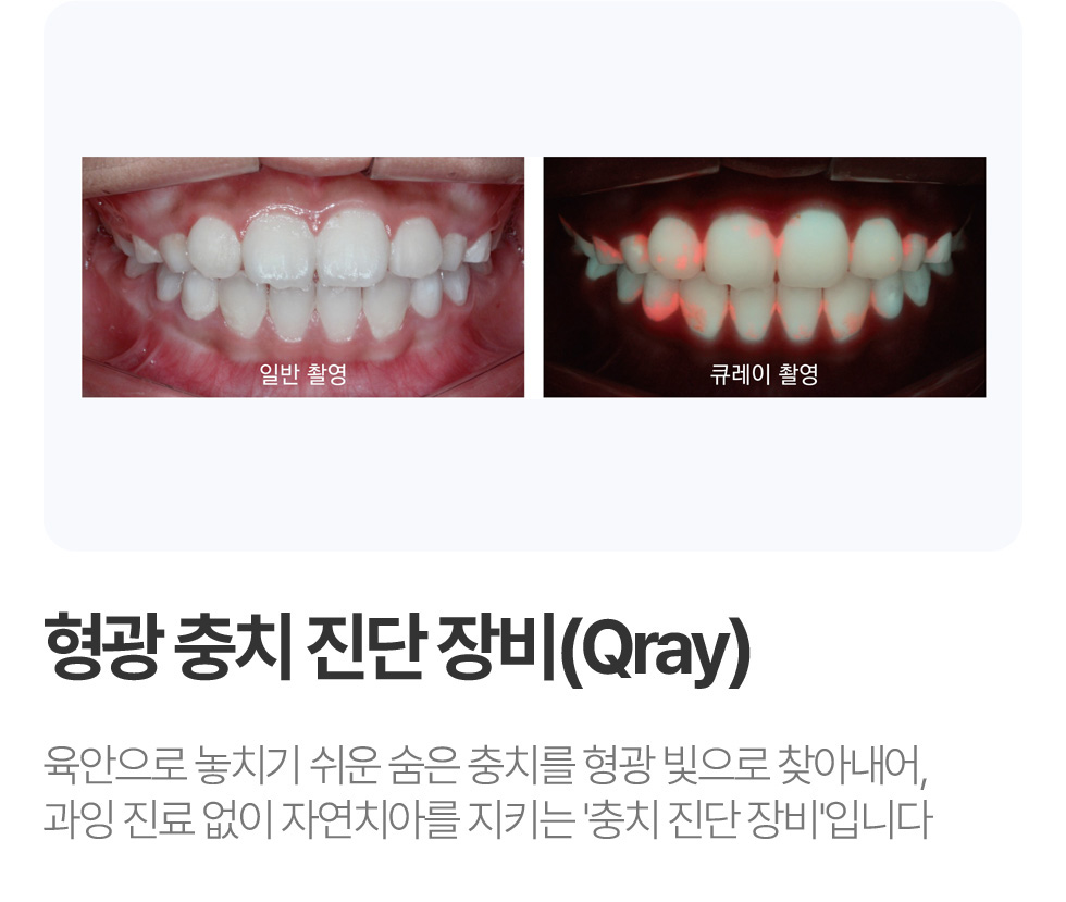 형광 충치 진단장비 (Qray)