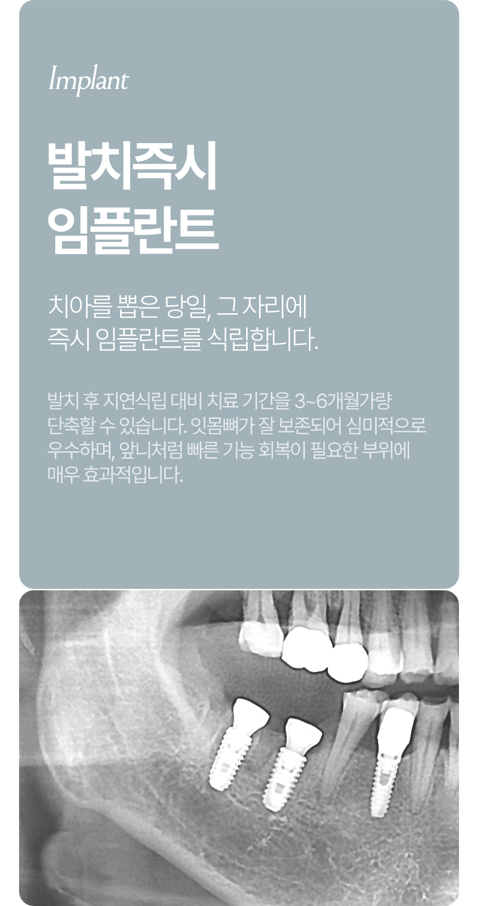 뼈이식 임플란트