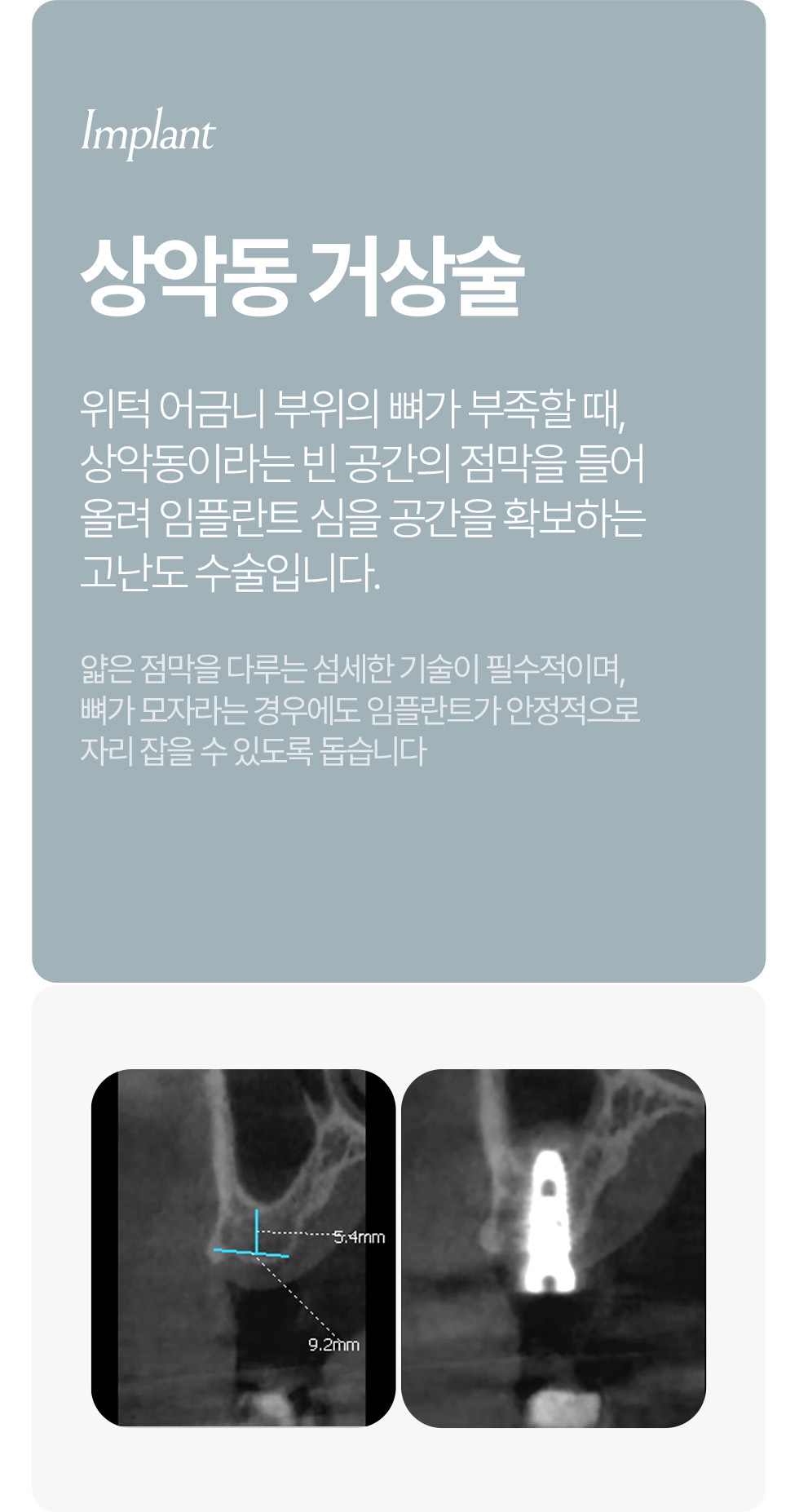 전악 임플란트