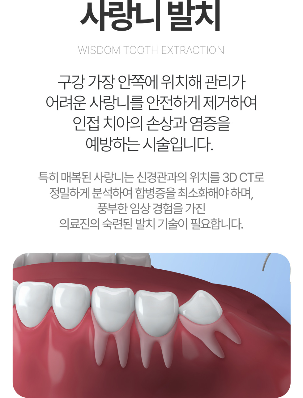 사랑니발치